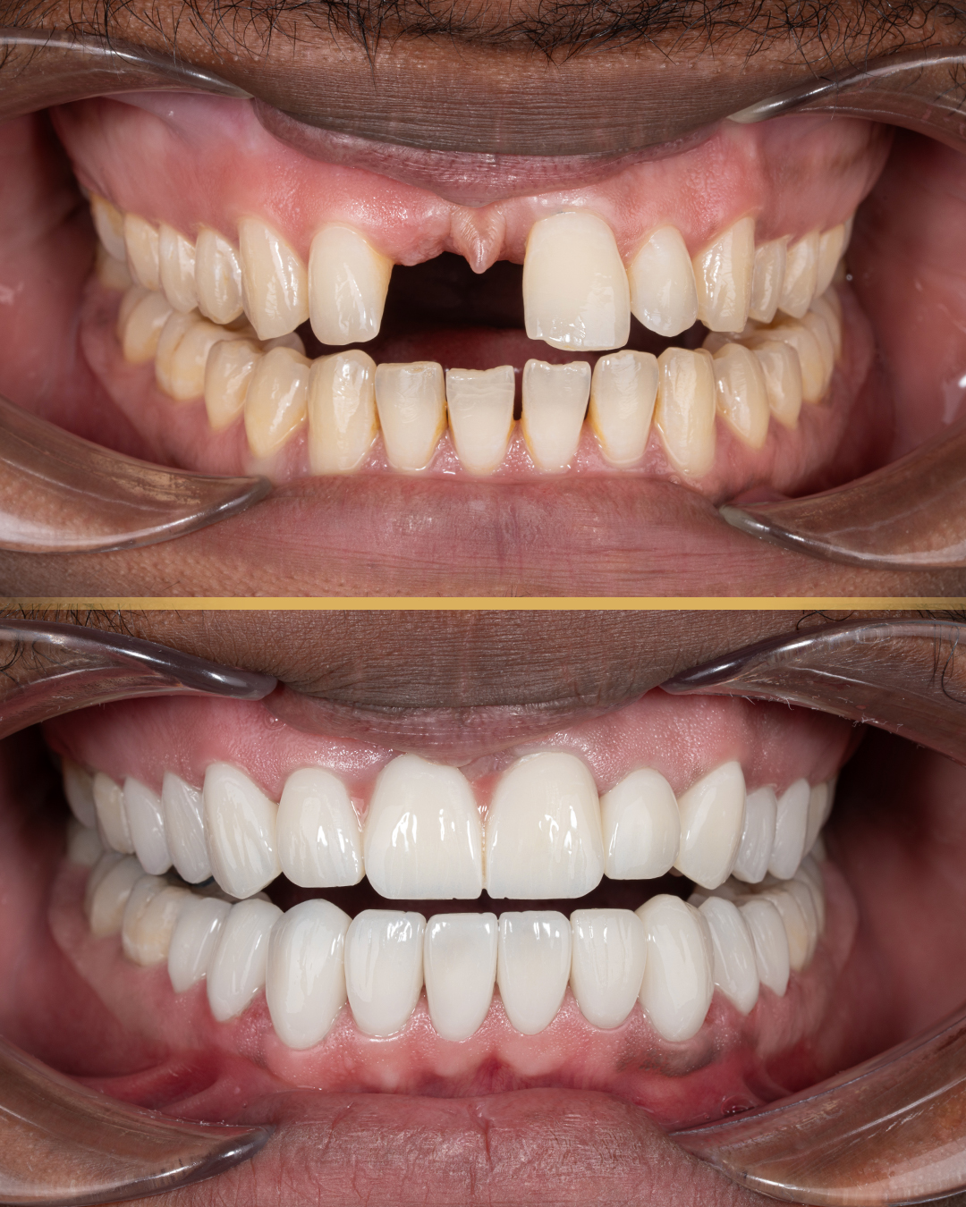 Folate Deficiency and Oral Health